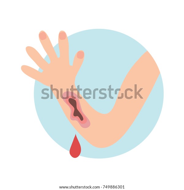 Wounded Hand Blood Oozing Blood Dripping Stock Vector (Royalty Free ...