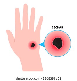 Wounds on hand and skin infection with eschar or scrub typhus the bacteremia sepsis in diabetes patient