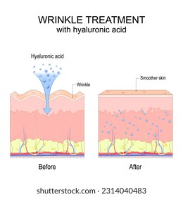 Wrinkle treatment with hyaluronic acid. Before and after procedure. Visible results. Smoother and Youthful skin. Poster for use in cosmetology, beauty, dermatology and aesthetic industry. Vector