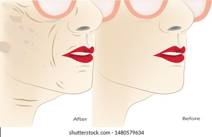 Wrinkles and aging in a woman 