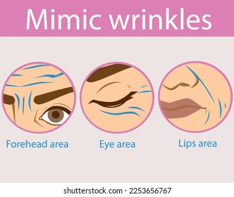 Wrinkles areas. Age skin. Wrinkles on the forehead.  Mimic wrinkles. Healthcare illustration. Vector illustration.