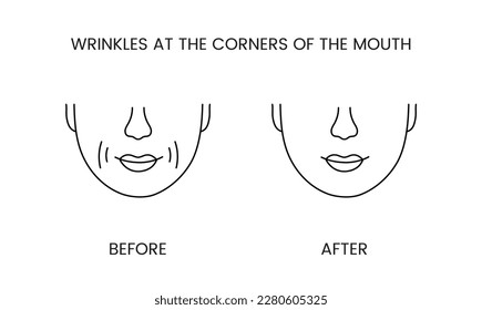 Wrinkles at the corners of the mouth, laser cosmetology before procedure and after applying treatment line icon in vector. Illustration of a man with smooth clean skin and wrinkles