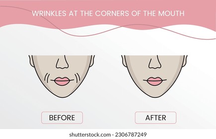 Wrinkles at the corners of the mouth, laser cosmetology before procedure and after applying treatment in vector. Illustration of a woman with smooth clean skin and problematic skin.