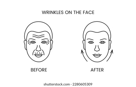 Wrinkles on the face, laser cosmetology before procedure and after applying treatment line icon in vector. Illustration of a man with smooth clean skin and wrinkles