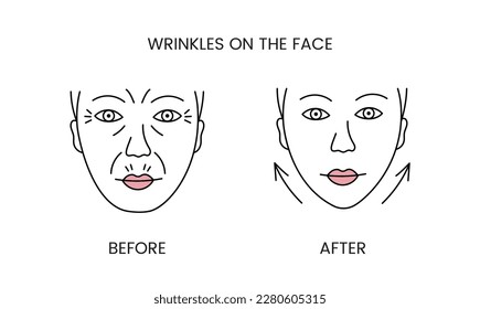 Falten auf dem Gesicht, Laserkosmetologie vor dem Eingriff und nach dem Auftragen der Linie Symbol in Vektorgrafik. Illustration einer Frau mit glatter, sauberer Haut und problematischer Haut.