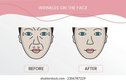 Wrinkles on the face, laser cosmetology before procedure and after applying treatment in vector. Illustration of a woman with smooth clean skin and problematic skin.