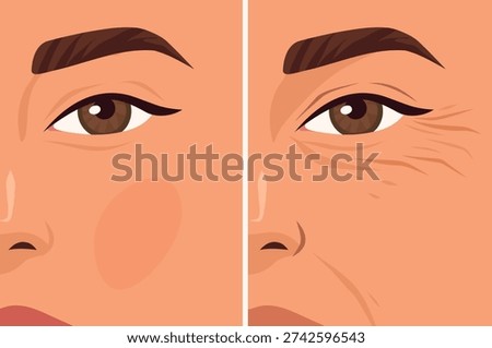 Wrinkles on the face, under the eyes. Vector illustration, young and aged facial skin. Smooth, taut skin and wrinkles, sagging, loss of volume. For anti-aging products, skin care, cosmetic surgery