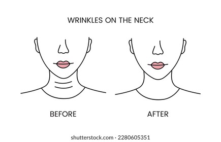 Wrinkles on the neck, laser cosmetology before procedure and after applying treatment line icon in vector. Illustration of a woman with smooth clean skin and problematic skin.