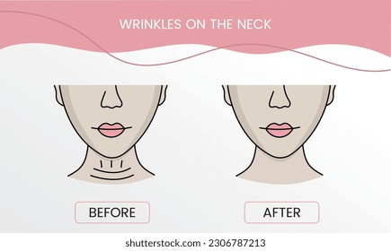Wrinkles on the neck, laser cosmetology before procedure and after applying treatment in vector. Illustration of a woman with smooth clean skin and problematic skin.