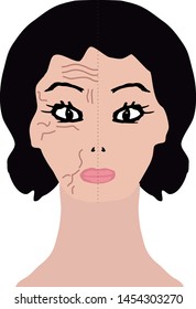 Wrinkles on one half of the face. Treatment with hyaluronic acid. Infographics. Vector illustration on isolated background.