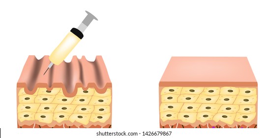 Wrinkles On The Skin. Botox Wrinkle Treatment. Anatomical Skin Structure. Botox Injection. Infographics. Vector Illustration On Isolated Background.