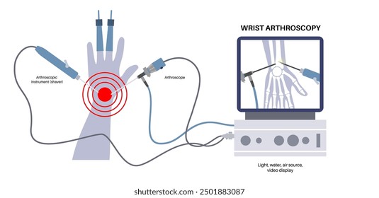 Cirugía de artroscopia de muñeca. Procedimiento mínimamente invasivo. Dolor, lesión e inflamación en el brazo humano. Artroscopio e instrumento artroscópico. Tratamiento de huesos de la mano ilustración médica de Vector plano