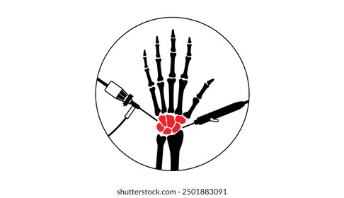 Wrist arthroscopy surgery. Minimal invasive procedure. Pain, injury and inflammation in the human arm. Arthroscope and arthroscopic instrument. Treatment of hand bones flat vector medical illustration