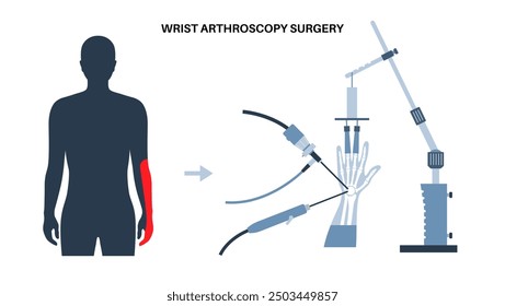 Cirugía de artroscopia de muñeca. Procedimiento mínimamente invasivo. Dolor, lesión e inflamación en el brazo humano. Artroscopio, dispositivo de torre de tracción e instrumento artroscópico. Tratamiento del Vector de los huesos de la mano