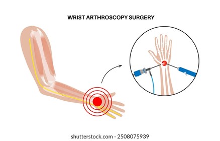 Wrist arthroscopy surgery. Minimal invasive procedure. Pain, injury, inflammation in the human arm. Arthroscope and arthroscopic instrument. Bones of hand, ligament, tendons and muscles anatomy vector