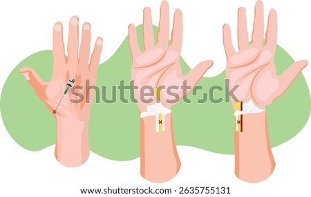 A wrist block is a regional anesthesia technique used to numb the hand and wrist area during surgical or diagnostic procedures typically targeting the radial, ulnar, and median nerves