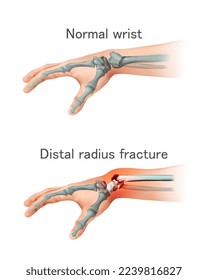 Wrist bone injury. Vector illustration.