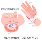 Wrist pain with the Quervain