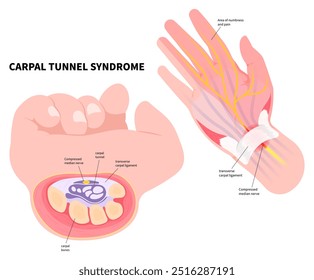 Wrist pain with the Quervain's tenosynovitis disease sign and Carpal tunnel syndrome test