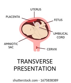 Wrong baby position in the uterus during pregnancy. transverse lies. Colored medical vector illustration. Fetus with umbilical cord and placenta.
