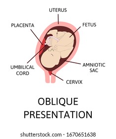 Wrong baby positions in the uterus during pregnancy. Oblique lies. Colored medical vector illustration. Fetus with umbilical cord and placenta.

