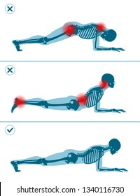 Wrong And Correct Plank Position. Right And Wrong Execution Technique Of Sport Exercise. Common Mistakes In Sport Workout. Man Standing On Elbows.