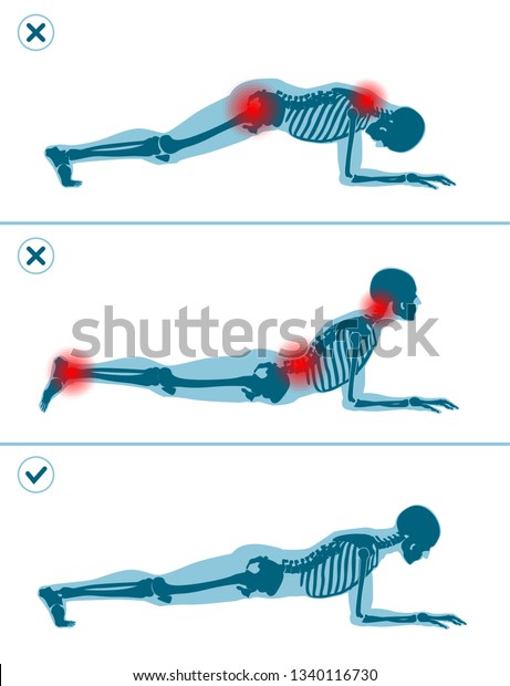 Wrong and correct plank position. Right and wrong\
execution technique of sport exercise. Common mistakes in sport\
workout. Man standing on\
elbows.