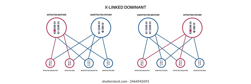 X verknüpftes dominantes Vererbungsmuster. Kind erbt eine Kopie eines mutierten Gens von jedem Elternteil. Genetische Erkrankung oder Störung. Betroffene, Träger oder gesunde X- und Y-Chromosomen-Vektorillustration.