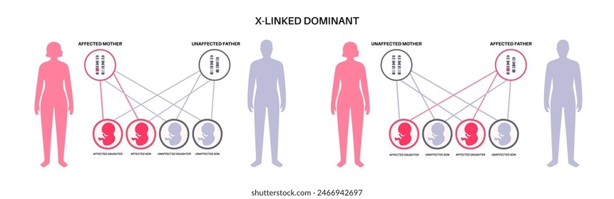 X verknüpftes dominantes Vererbungsmuster. Kind erbt eine Kopie eines mutierten Gens von jedem Elternteil. Genetische Erkrankung oder Störung. Betroffene, Träger oder gesunde X- und Y-Chromosomen-Vektorillustration.