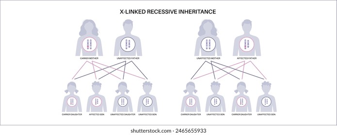 X Verknüpftes rezessives Vererbungsmuster. Kind erbt eine Kopie eines mutierten Gens von jedem Elternteil. Genetische Erkrankung oder Störung. Betroffene, Träger oder gesunde X- und Y-Chromosomen-Vektorillustration.