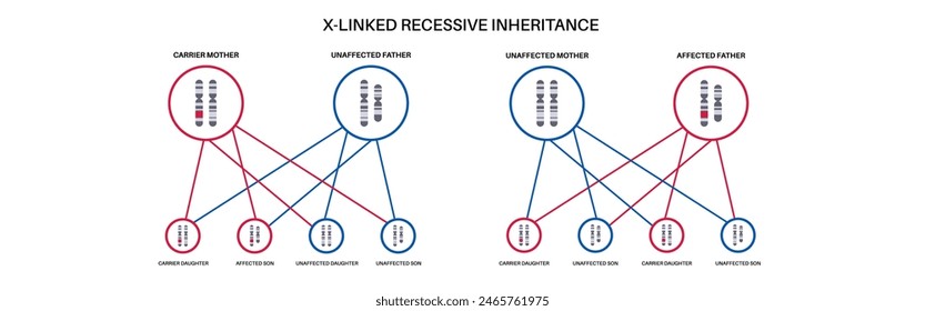 X Verknüpftes rezessives Vererbungsmuster. Kind erbt eine Kopie eines mutierten Gens von jedem Elternteil. Genetische Erkrankung oder Störung. Betroffene, Träger oder gesunde X- und Y-Chromosomen-Vektorillustration.