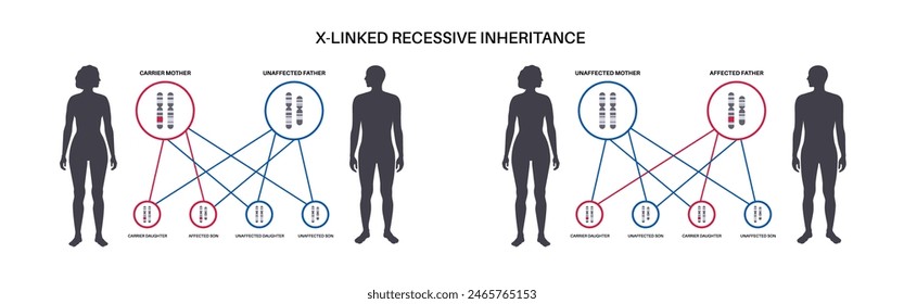 X Verknüpftes rezessives Vererbungsmuster. Kind erbt eine Kopie eines mutierten Gens von jedem Elternteil. Genetische Erkrankung oder Störung. Betroffene, Träger oder gesunde X- und Y-Chromosomen-Vektorillustration.