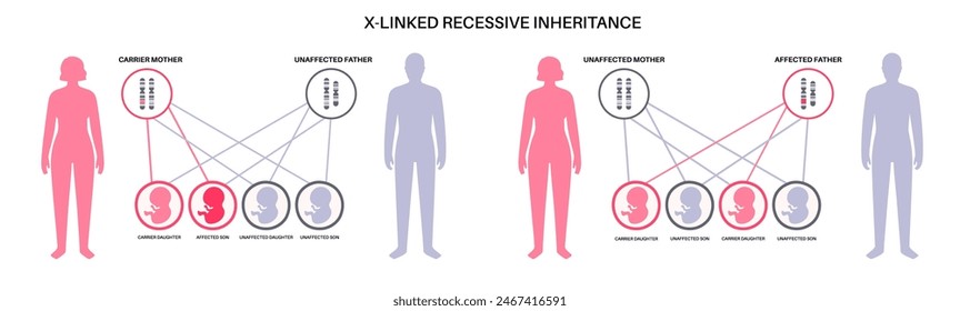 X Verknüpftes rezessives Vererbungsmuster. Kind erbt eine Kopie eines mutierten Gens von jedem Elternteil. Genetische Erkrankung oder Störung. Betroffene, Träger oder gesunde X- und Y-Chromosomen-Vektorillustration.