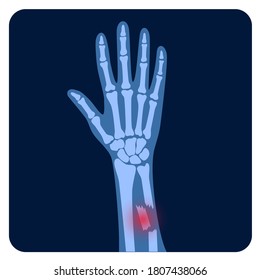 X ray of arm fracture with red pain point. Broken hand with Inner closed comminuted type of fracture. Human skeleton anatomy concept. Medical banner for clinic or hospital. Flat vector illustration.