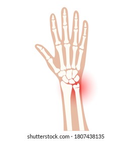 X ray of arm fracture with red pain point and inflammination. Broken hand with Inner closed greenstick distal type of fracture. Human skeleton anatomy concept. Medical banner. Flat vector illustration