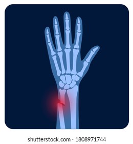 X ray of arm fracture with red pain point and inflammination. Broken hand with open type of fracture. Human skeleton anatomy concept. Medical banner for clinic or hospital. Flat vector illustration