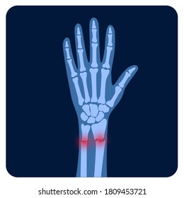 X ray of arm fracture with red pain or inflammation points. Broken hand with Inner closed radius type of fracture. Human skeleton anatomy concept. Medical banner for clinic. Flat vector illustration.