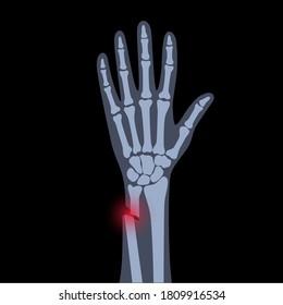 X ray of arm fracture with red pain point and inflammination. Broken hand with open type of fracture. Human skeleton anatomy concept. Medical banner for clinic or hospital. Flat vector illustration