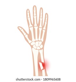 Rayo X de fractura de brazo con punto de dolor rojo. Mano rota con el tipo de fractura cerrada interior. Concepto de anatomía del esqueleto humano. Cartel médico para clínica u hospital. Ilustración vectorial plana.