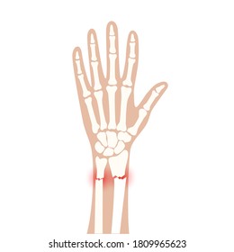 X Ray Of Arm Fracture With Red Pain Or Inflammation Points. Broken Hand With Inner Closed Radius Type Of Fracture. Human Skeleton Anatomy Concept. Medical Banner For Clinic. Flat Vector Illustration.