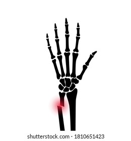 X ray of arm fracture with red pain point and inflammination. Broken hand with open type of fracture. Human skeleton anatomy concept. Medical banner for clinic or hospital. Flat vector illustration