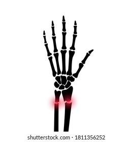 X ray of arm fracture with red pain or inflammation points. Broken hand with Inner closed radius type of fracture. Human skeleton anatomy concept. Medical banner for clinic. Flat vector illustration.