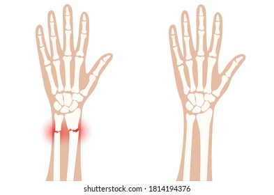 Rayo X de fractura de brazo con puntos de dolor rojo y brazo normal. Mano rota con un radio cerrado interior tipo de fractura. Concepto de anatomía del esqueleto humano. Cartel médico para la clínica. Ilustración vectorial plana.