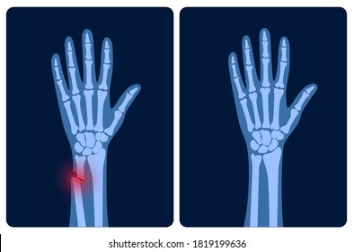 X Ray Of Arm Fracture With Red Pain Point And Inflammination. Broken Hand With Open Type Of Fracture. Human Skeleton Anatomy Concept. Medical Banner For Clinic Or Hospital. Flat Vector Illustration