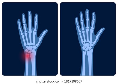 X ray of arm fracture with red pain point and normal arm. Broken hand with Inner closed greenstick distal type of fracture. Human skeleton anatomy concept. Medical banner. Flat vector illustration.