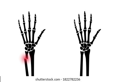 X ray of arm fracture with red pain point and inflammination. Broken hand with open type of fracture. Human skeleton anatomy concept. Medical banner for clinic or hospital. Flat vector illustration