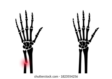 Röntgenaufnahme von Armbrüchen mit rotem Schmerzpunkt und normalem Arm. Geschlossene Hand mit geschlossener Innere Grubenkrebse. Anatomie des menschlichen Skeletts Medizinischer Banner für Kliniken. Flache Vektorgrafik