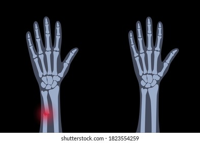X ray of arm fracture with red pain point and normal arm. Broken hand with Inner closed greenstick type of fracture. Human skeleton anatomy concept. Medical banner for clinic. Flat vector illustration