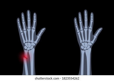 Rayo X de fractura de brazo con punto de dolor rojo e inflamación. Mano rota con tipo abierto de fractura. Concepto de anatomía del esqueleto humano. Cartel médico para clínica u hospital. Ilustración vectorial plana