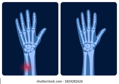 X ray of arm fracture with red pain points and normal arm. Broken hand with Inner closed radius type of fracture. Human skeleton anatomy concept. Medical banner for clinic. Flat vector illustration.
